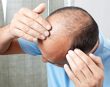 MAn-suffering-from-hair-loss