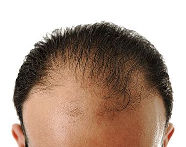 Male-Hair-Loss